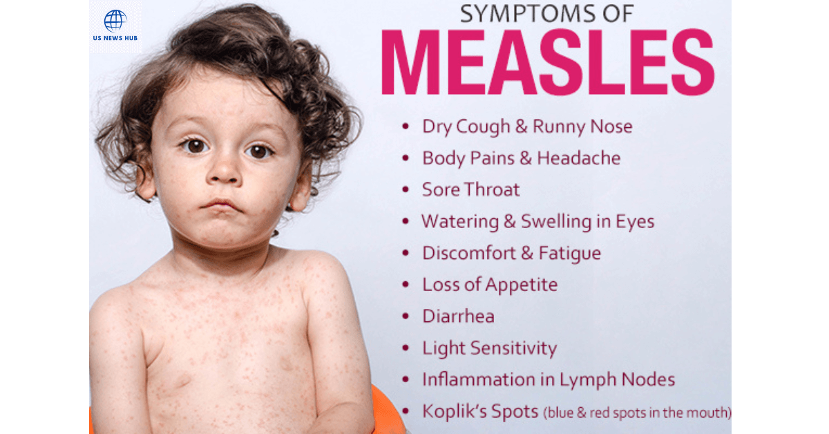 Read more about the article Measles Symptoms: Everything You Need to Know